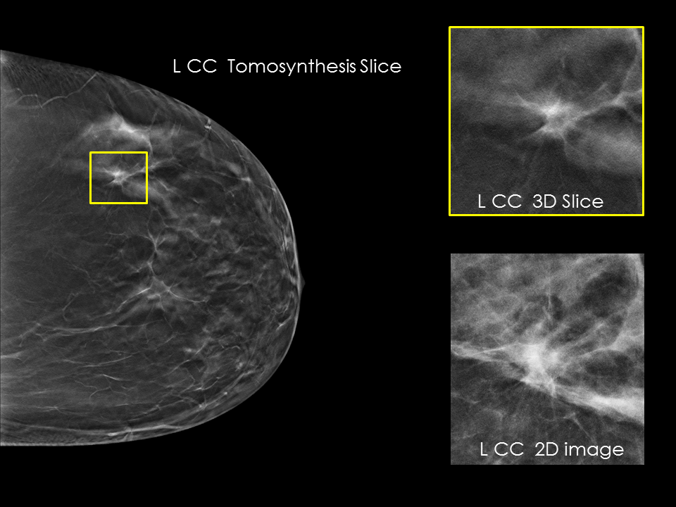 3Dimensions™ Mammography System Hologic